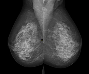 Mammogram